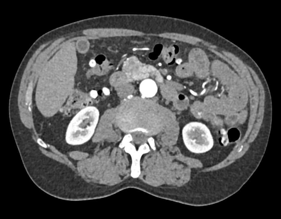 Serous Cystadenoma in the Head of the Pancreas - CTisus CT Scan