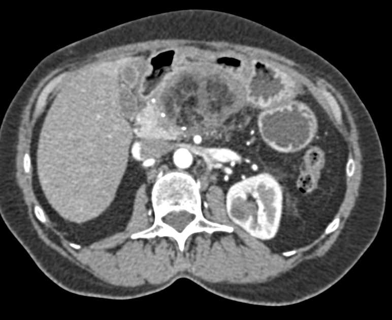 Omental Infarct s/p Distal Pancreatectomy - CTisus CT Scan