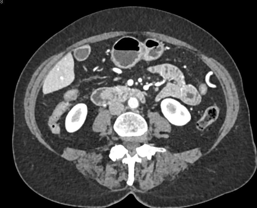 Ampullary Cancer and Additional Tumor in the Tail of the Pancreas - CTisus CT Scan