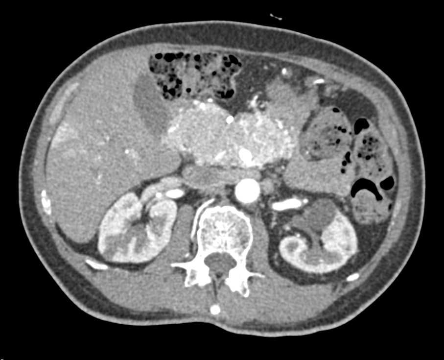 Neuroendocrine Tumor of the Pancreas with Liver Metastases - CTisus CT Scan