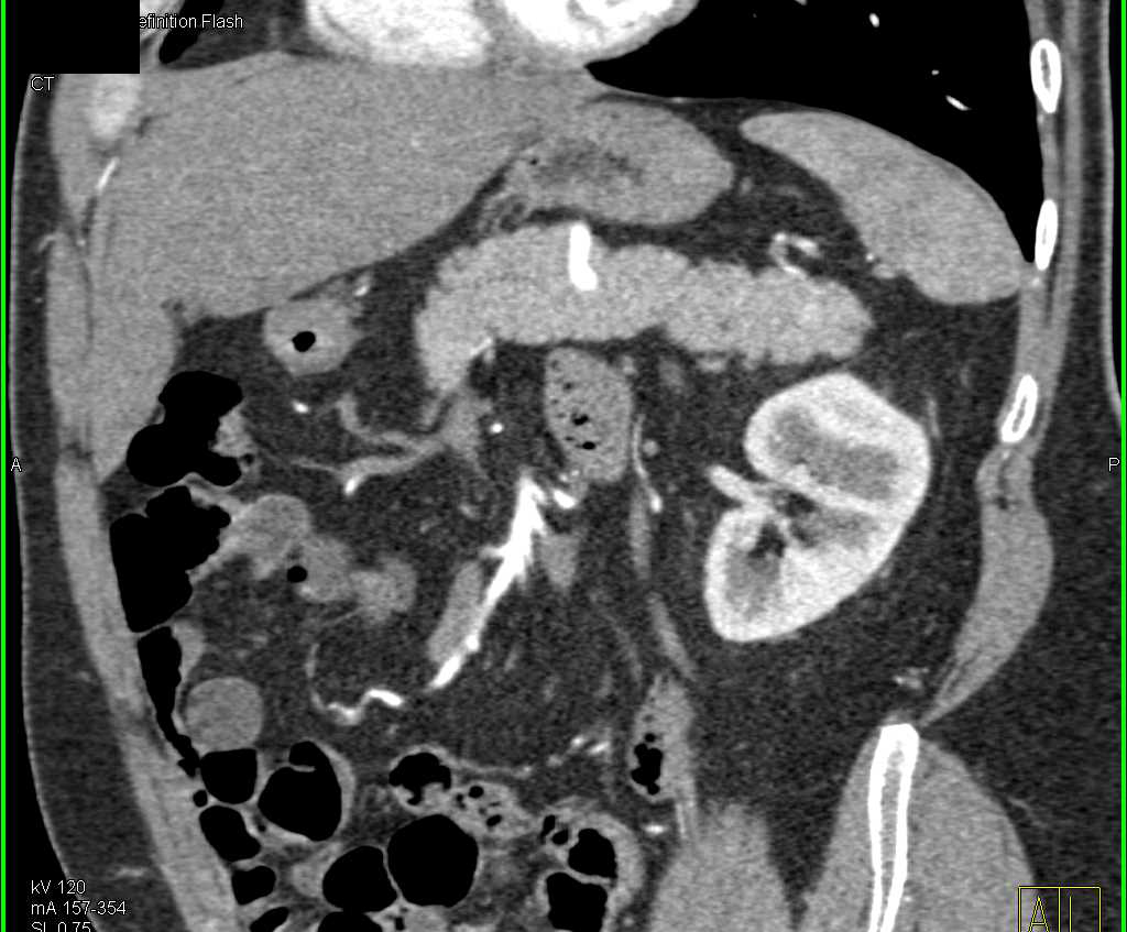 8mm Pancreatic Neuroendocrine Tumor (PNET) in the Tail of the Pancreas - CTisus CT Scan