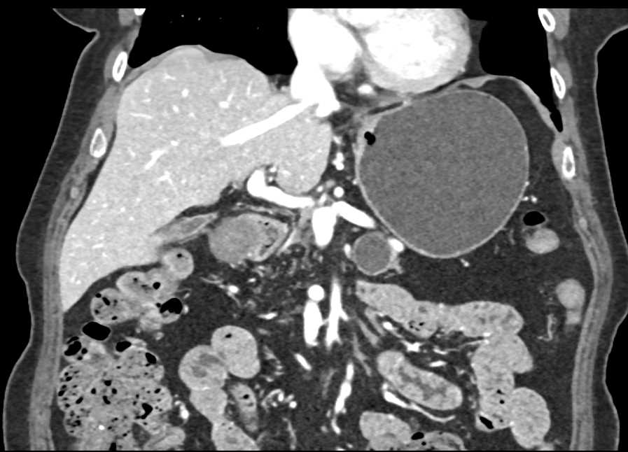 Intraductal Papillary Mucinous Neoplasm (IPMN) Pancreas - CTisus CT Scan