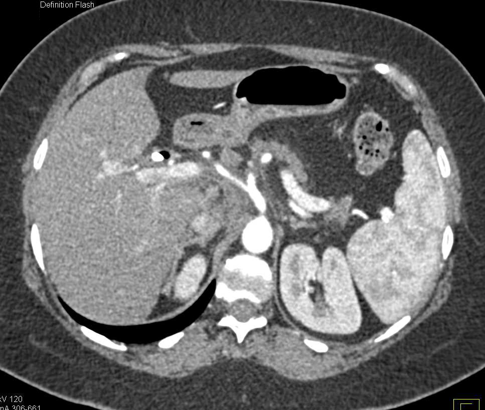 Pancreatic Cancer with Vascular Encasement - CTisus CT Scan