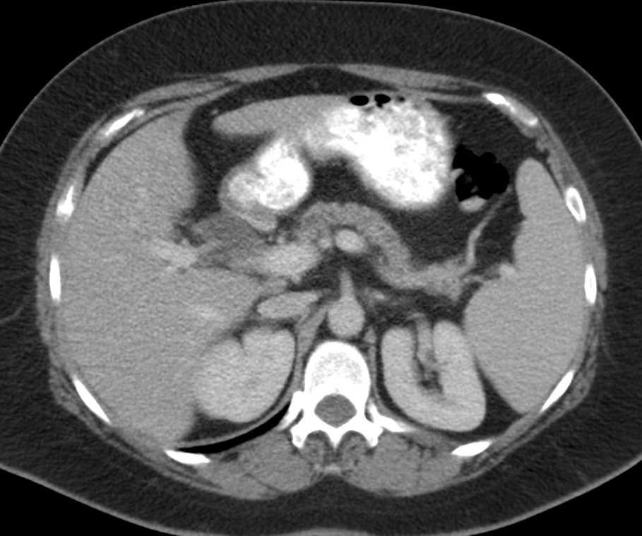 Carcinoma Head of the Pancreas - CTisus CT Scan