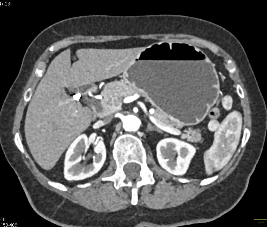 Subtle Carcinoma Body of the Pancreas with Atrophy of the Tail of the Pancreas - CTisus CT Scan