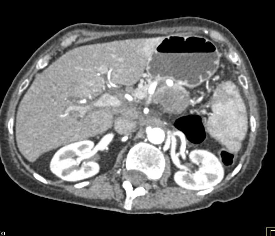 Pancreatic Adenocarcinoma with Liver Metastases and Left Femoral Vein Thrombosis - CTisus CT Scan