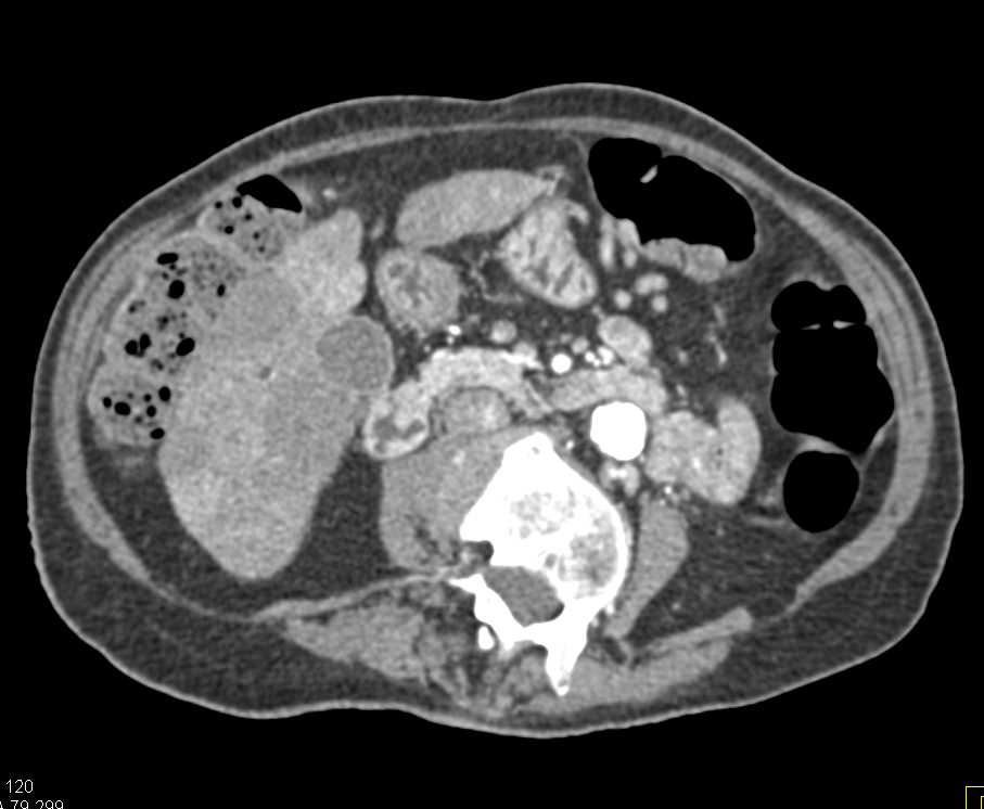Pancreatic Adenocarcinoma with Liver Metastases and Left Femoral Vein Thrombosis - CTisus CT Scan