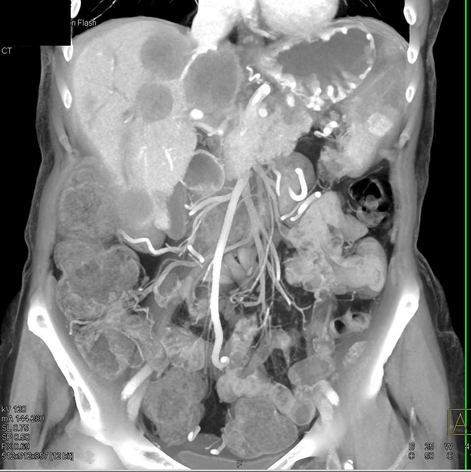 Pancreatic Adenocarcinoma with Liver Metastases and Splenic Infarcts and Pulmonary Embolism (PE) and Left Femoral Vein Thrombosis - CTisus CT Scan