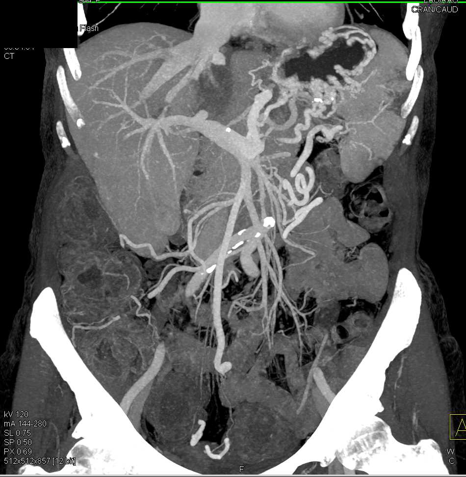 Pancreatic Adenocarcinoma with Liver Metastases and Splenic Infarcts and Pulmonary Embolism (PE) and Left Femoral Vein Thrombosis - CTisus CT Scan