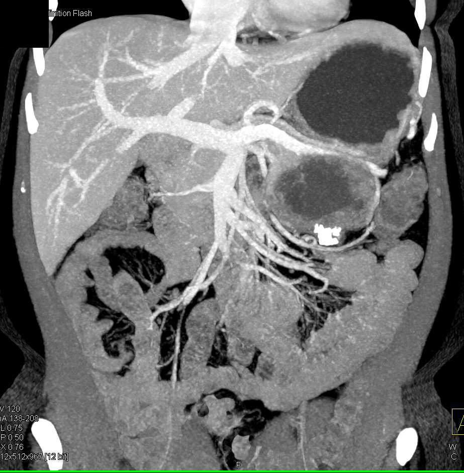 Cystic Pancreatic Neuroendocrine Tumor (PNET) Tumor Tail of the Pancreas - CTisus CT Scan