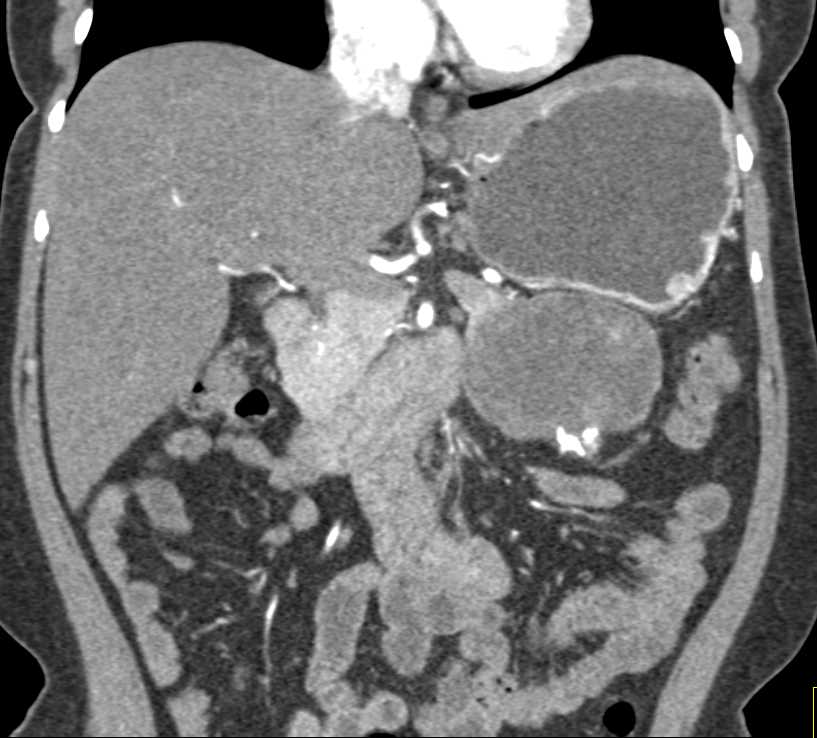Cystic Pancreatic Neuroendocrine Tumor (PNET) Tumor Tail of the Pancreas - CTisus CT Scan
