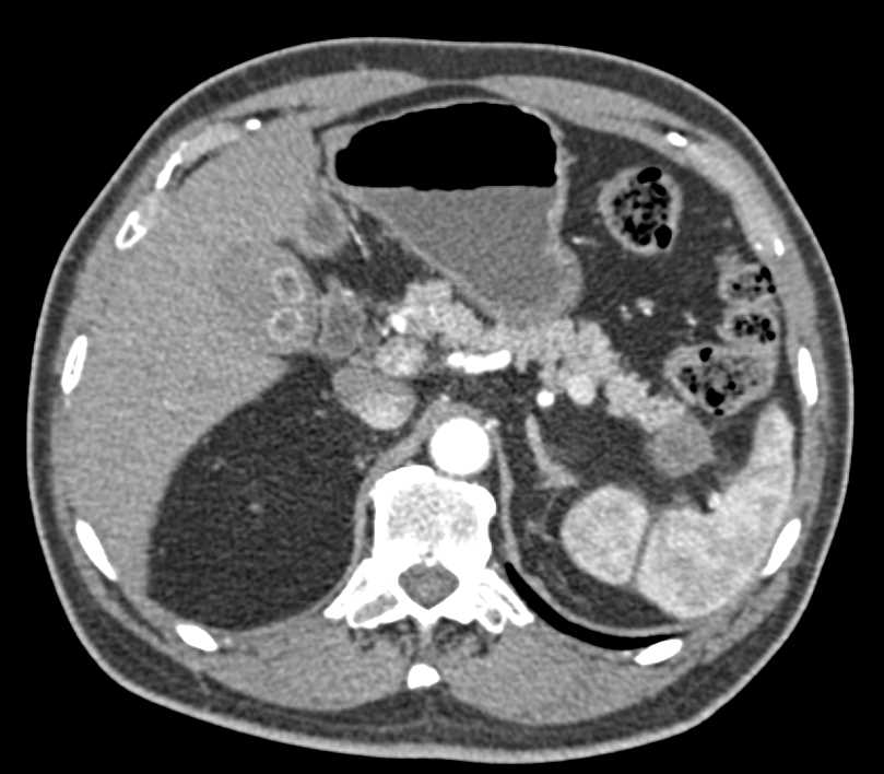 Carcinoma Tail of the Pancreas - CTisus CT Scan