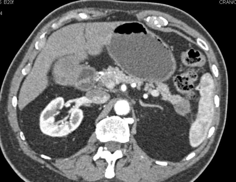 Carcinoma Tail of the Pancreas - CTisus CT Scan