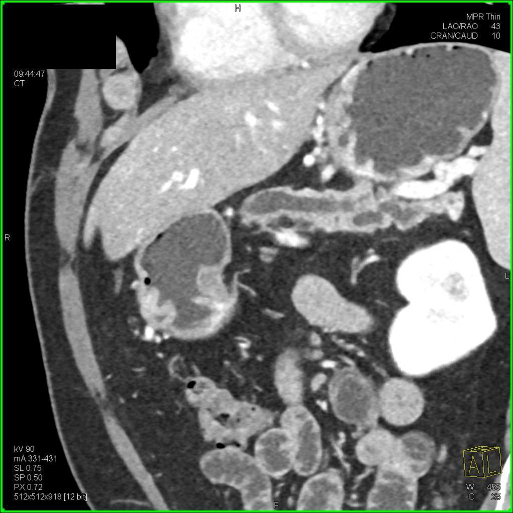 Dilated Pancreatic Duct with a Stone in the Common Duct - CTisus CT Scan