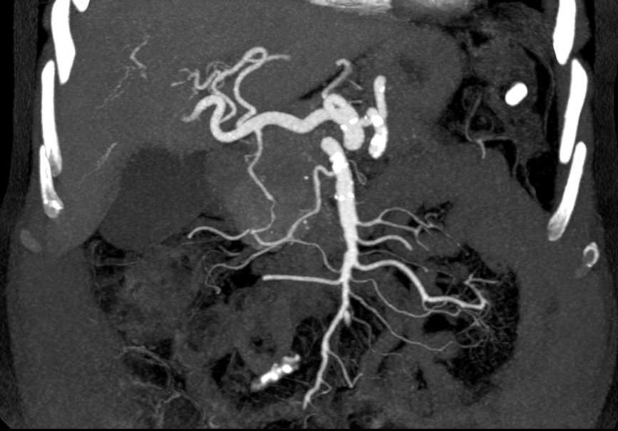 Pancreatic Cancer Invades the PV/SMV/SV Junction - CTisus CT Scan