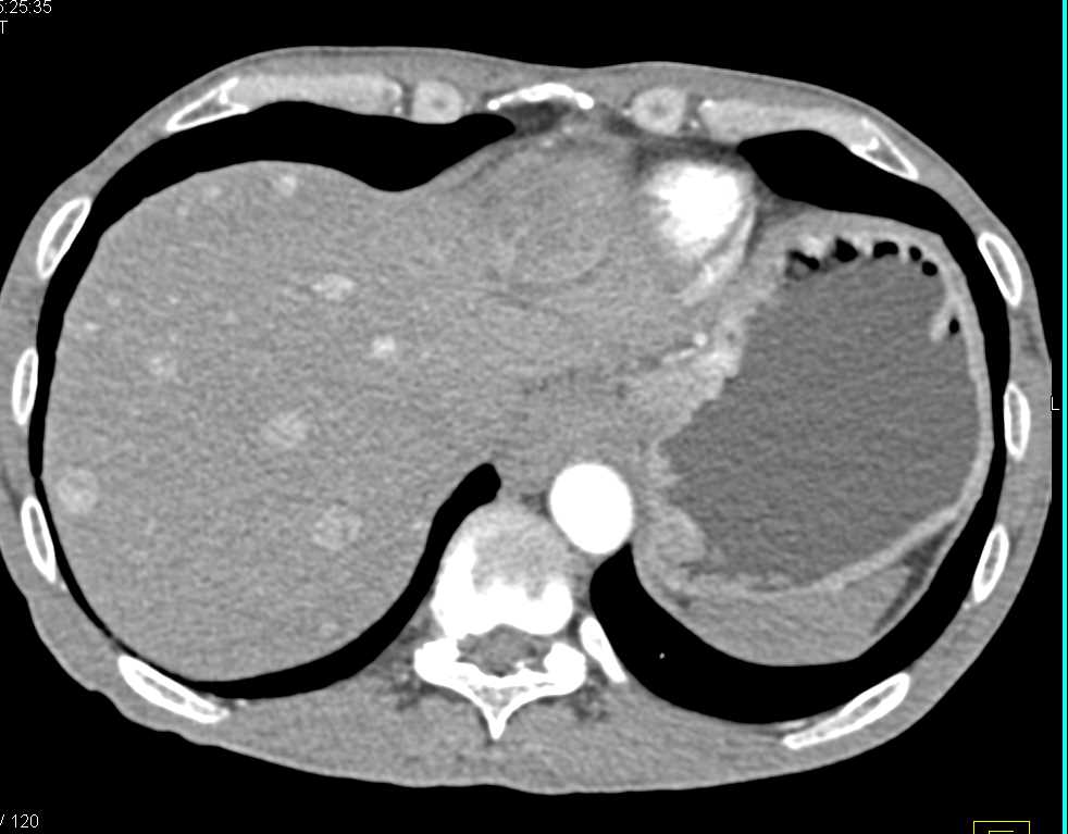 Liver Metastases from Neuroendocrine Tumor of the Pancreas - CTisus CT Scan