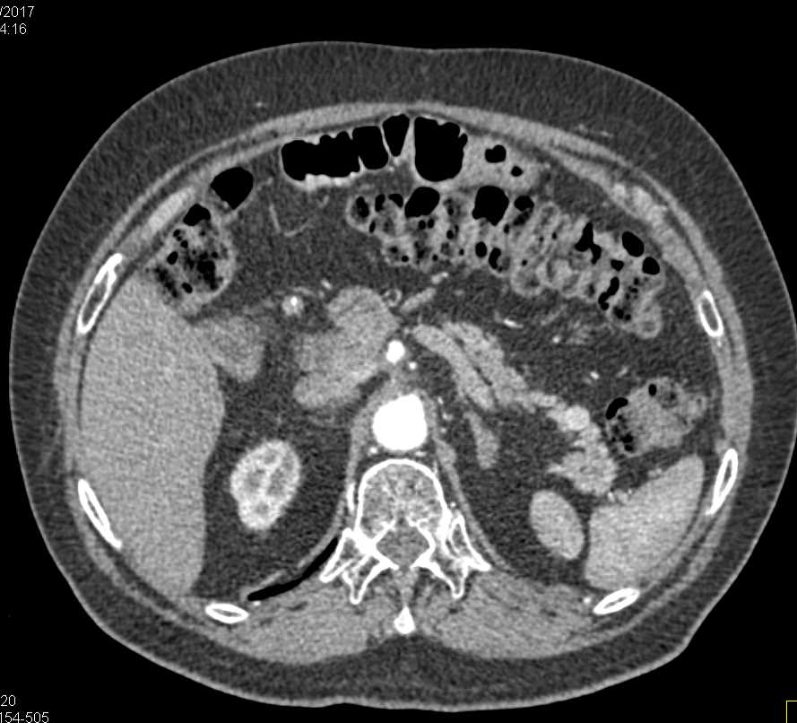 1cm Neuroendocrine Tumor Tail of Pancreas - CTisus CT Scan