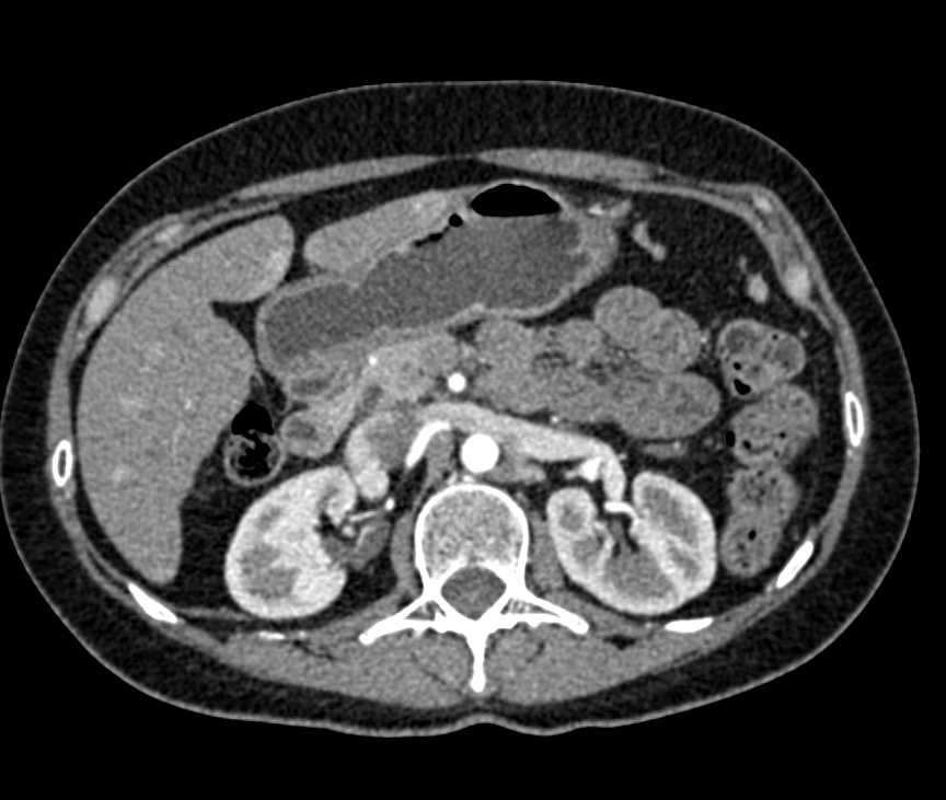 Neuroendocrine Tumor Pancreas with Liver Metastases - CTisus CT Scan