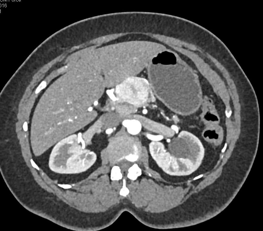 Neuroendocrine Tumor in the Body of the Pancreas - CTisus CT Scan