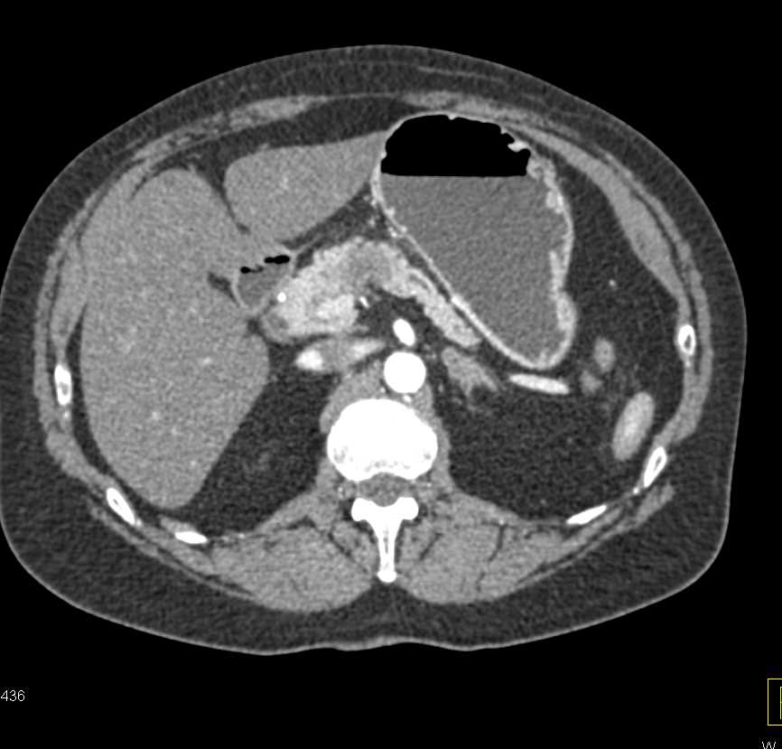 Adenocarcinoma of the Body of the Pancreas - CTisus CT Scan