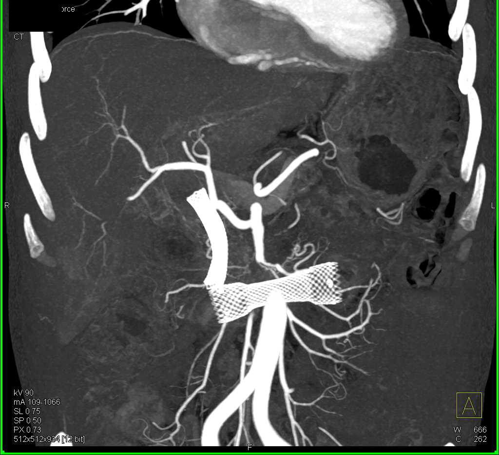 Invasive Pancreatic Cancer Encases the Duodenum with Stent in Place - CTisus CT Scan