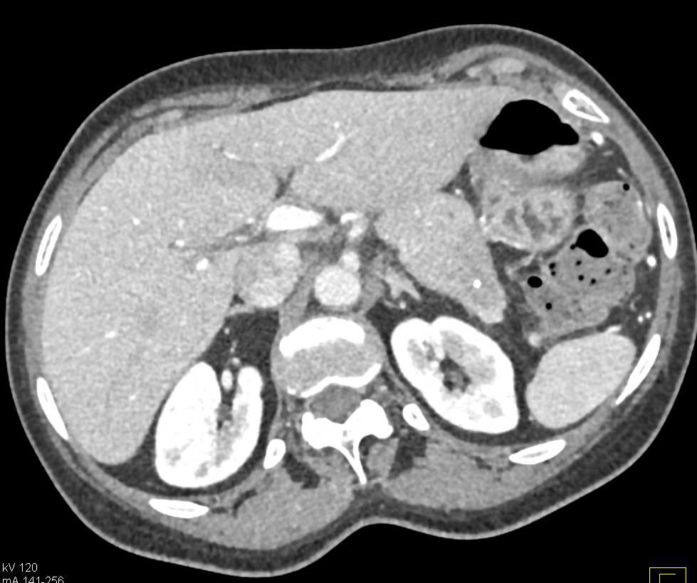 Carcinoma Tail of the Pancreas - CTisus CT Scan