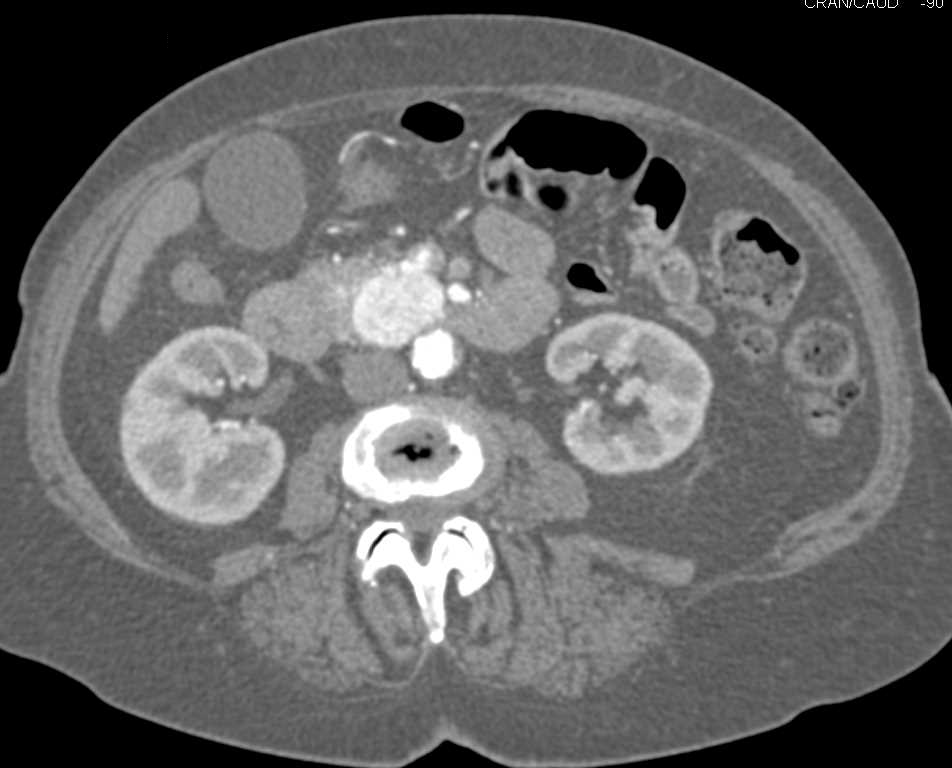 Neuroendocrine Tumor in the Head of the Pancreas - CTisus CT Scan