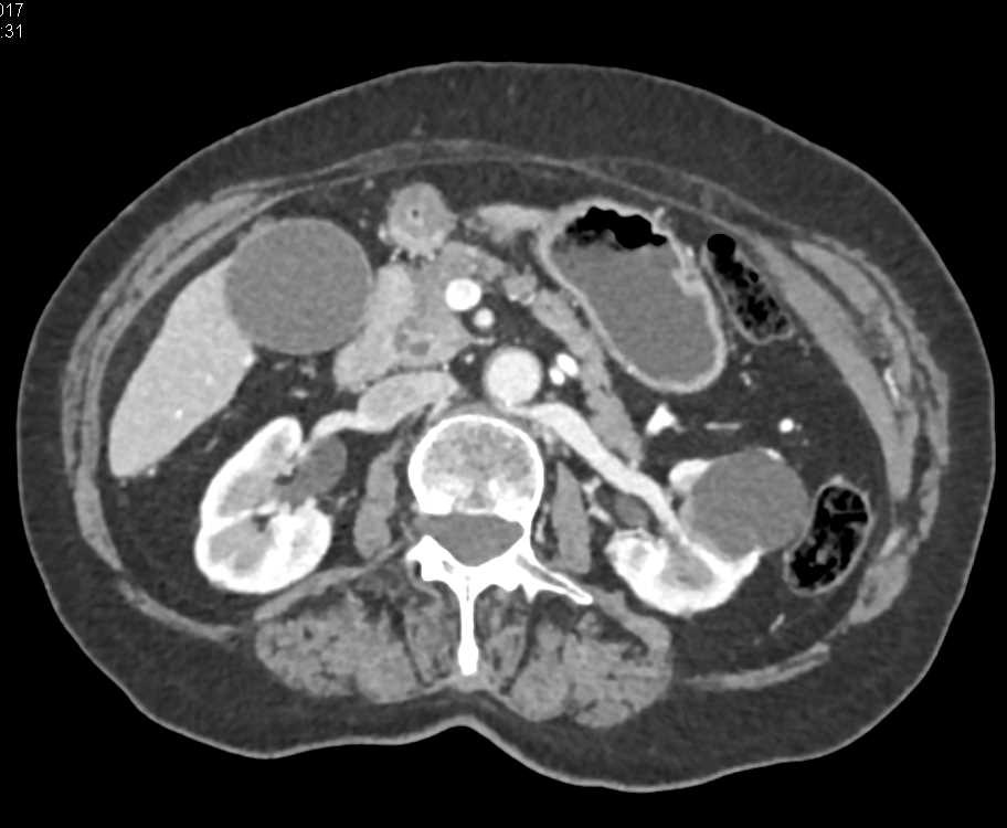 Adenocarcinoma of the Head of the Pancreas - CTisus CT Scan