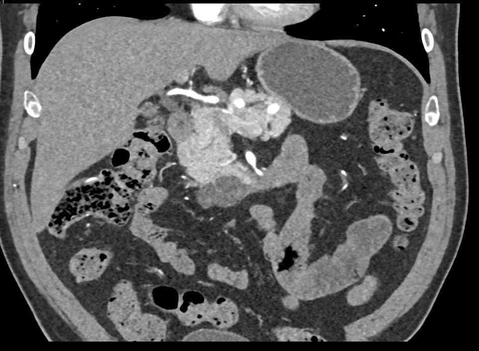 Intraductal Papillary Mucinous Neoplasm (IPMN) Head of the Pancreas - CTisus CT Scan