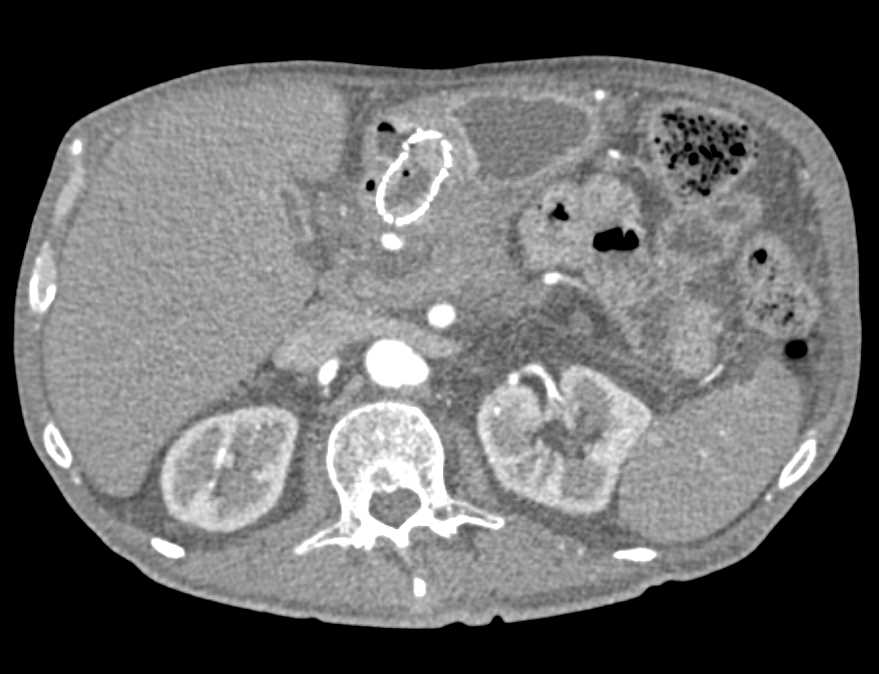 Incidental Renal Cell Carcinoma in a Patient with Pancreatic Adenocarcinoma - CTisus CT Scan