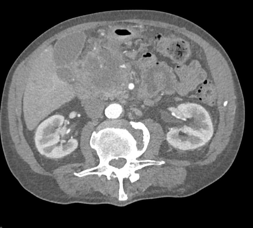 Invasive Adenocarcinoma Head of the Pancreas with Local Spread - CTisus CT Scan