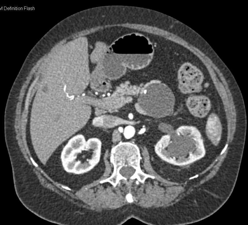 Mucinous Cystic Neoplasm Pancreas (MCN) - CTisus CT Scan