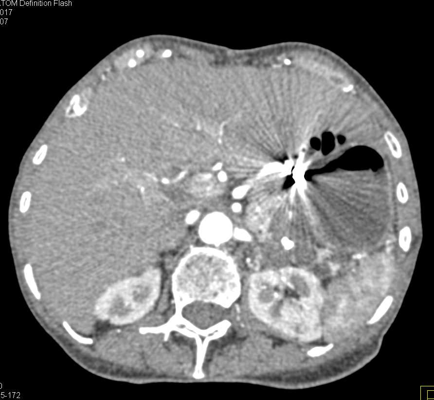 Pseudocyst Tail of Pancreas - CTisus CT Scan