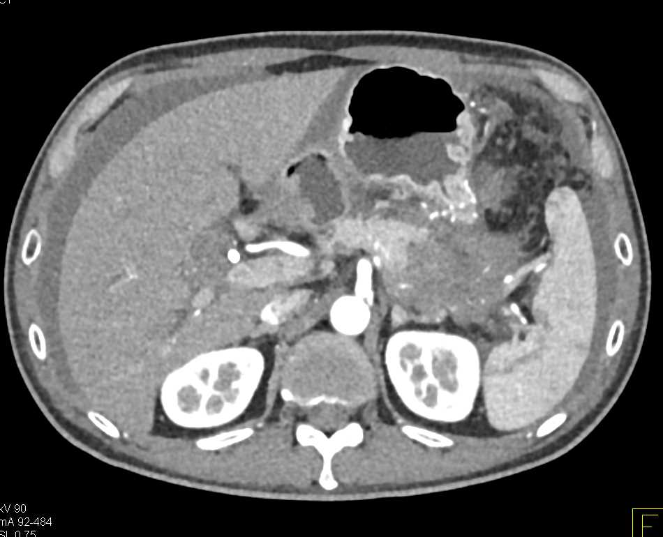 Carcinoma Tail of the Pancreas with Carcinomatosis - CTisus CT Scan