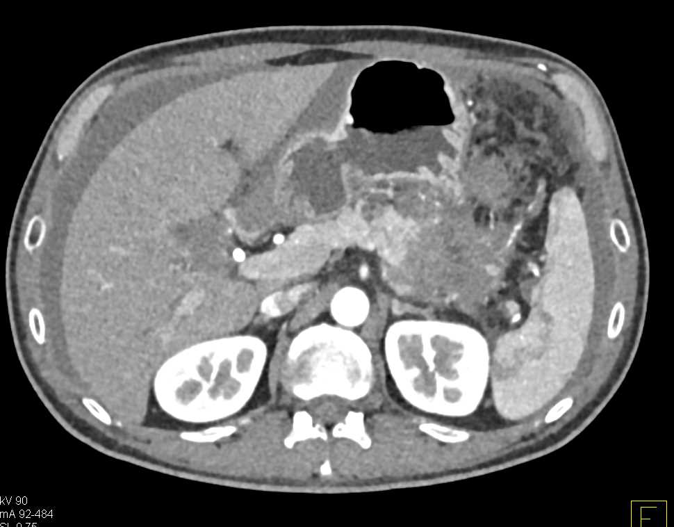 Carcinoma Tail of the Pancreas with Carcinomatosis - CTisus CT Scan