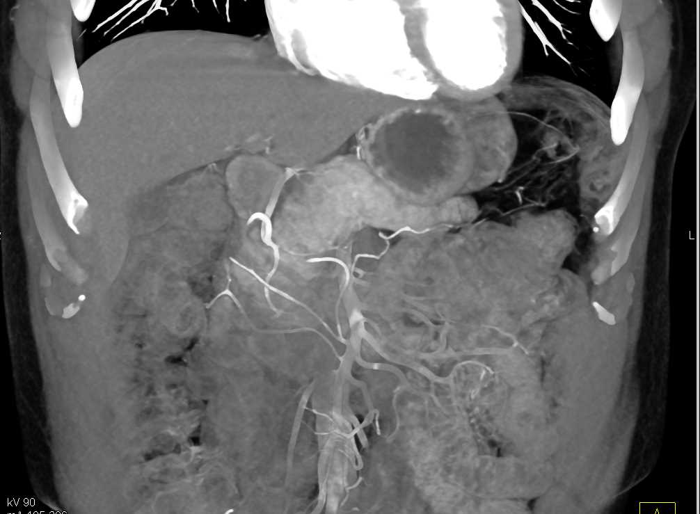 Serous Cystadenoma - CTisus CT Scan