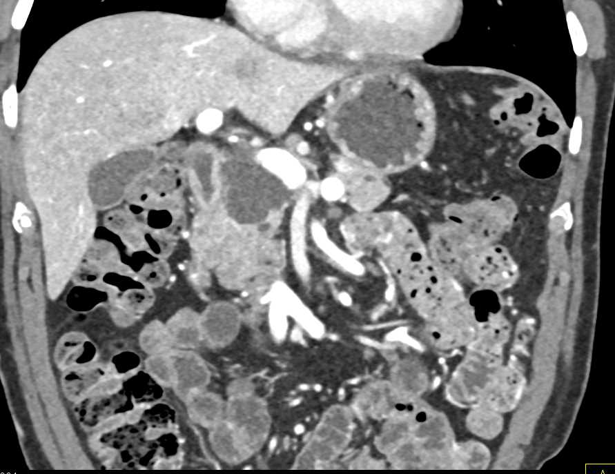 Serous Cystadenoma - CTisus CT Scan