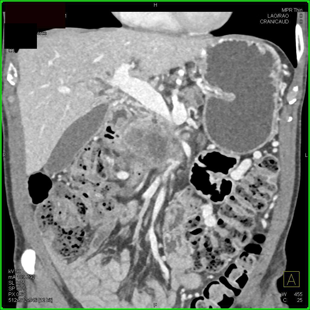 Pancreatic Adenocarcinoma with Liver Metastases - CTisus CT Scan