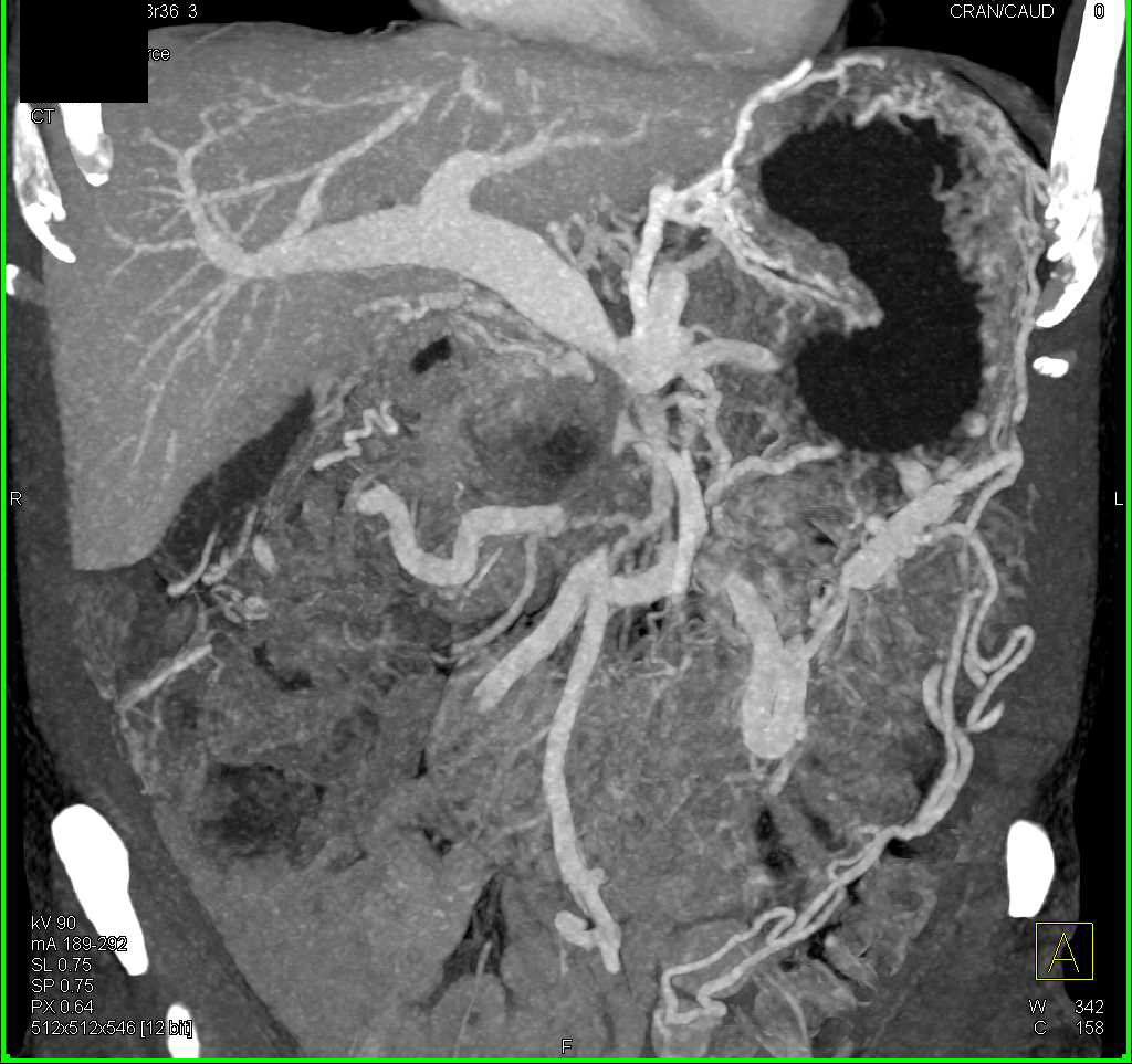Pancreatic Adenocarcinoma with Liver Metastases - CTisus CT Scan