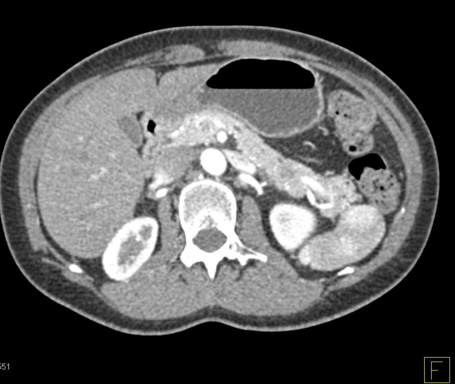 Subtle Carcinoma Tail of the Pancreas - CTisus CT Scan