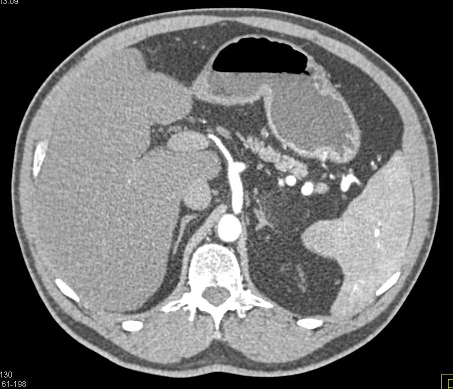 Pancreatic Neuroendocrine Tumor (PNET) Head of Pancreas and Left Adrenal Myelolipoma - CTisus CT Scan