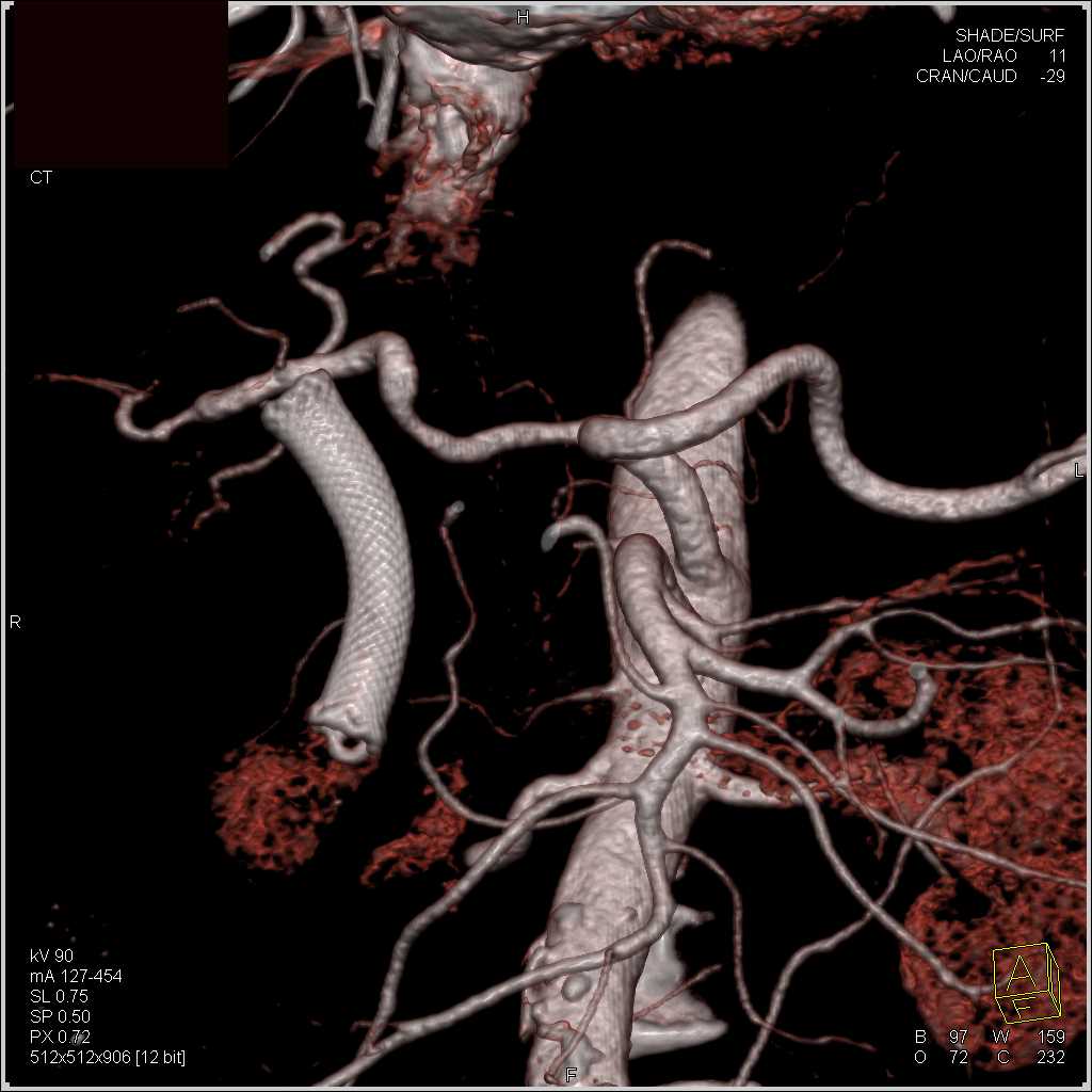 Pancreatic Cancer Encases the Portal Vein and the Superior Mesenteric Vein (SMV) - CTisus CT Scan