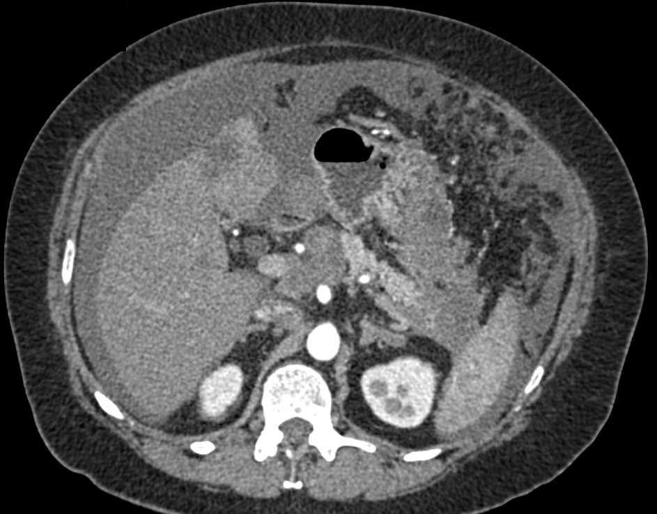 Carcinoma Tail of the Pancreas with Carcinomatosis - CTisus CT Scan