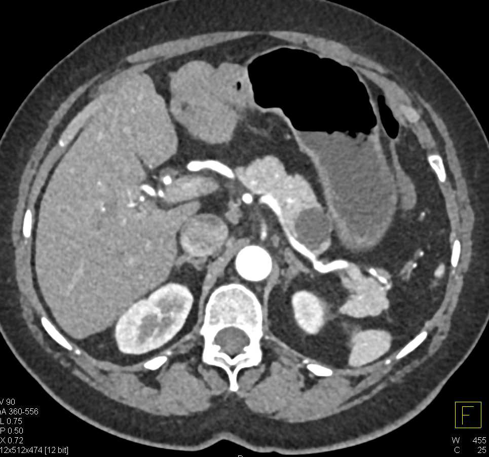 Multiple Intraductal Papillary Mucinous Neoplasms (IPMNs) in the Tail of the Pancreas - CTisus CT Scan