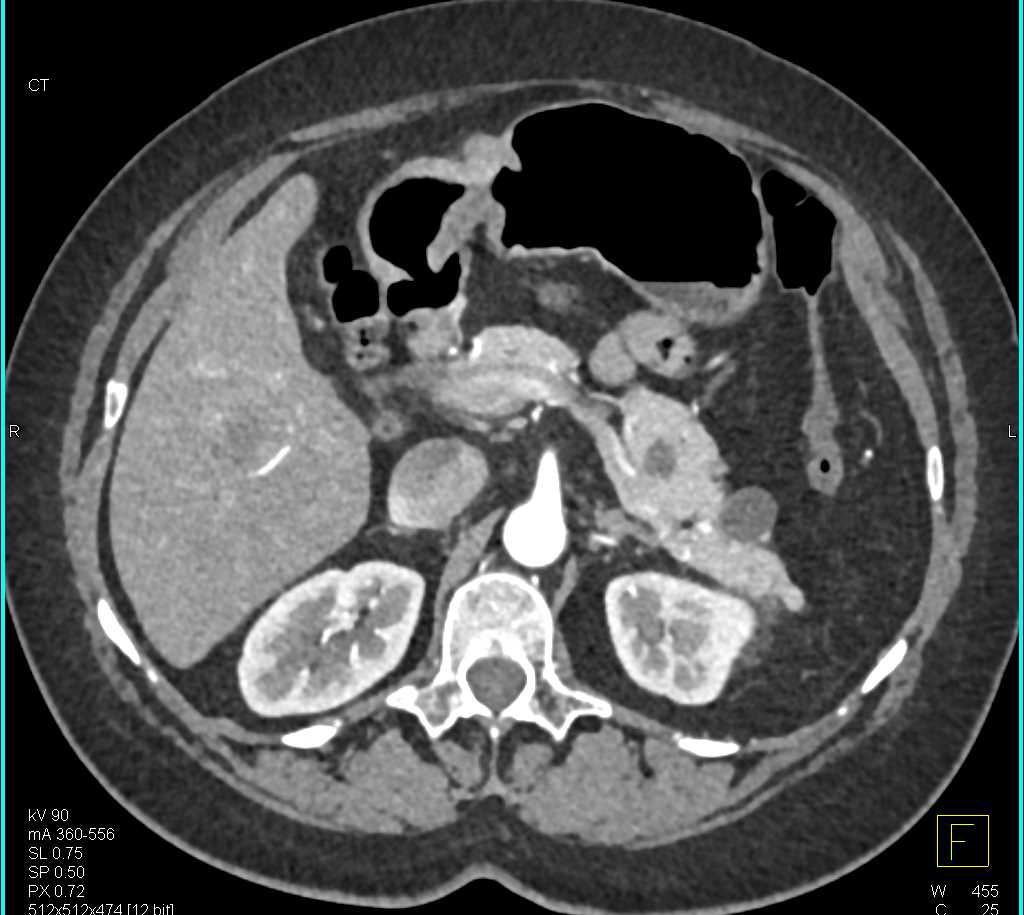 Multiple Intraductal Papillary Mucinous Neoplasms (IPMNs) in the Tail of the Pancreas - CTisus CT Scan