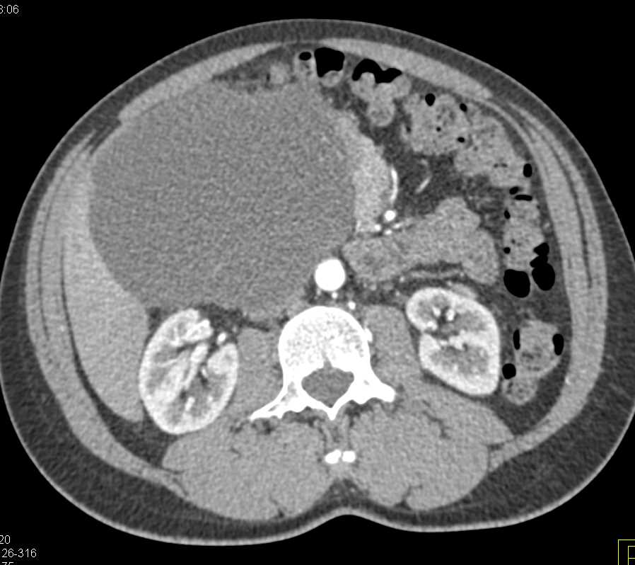 Serous Cystadenoma - CTisus CT Scan