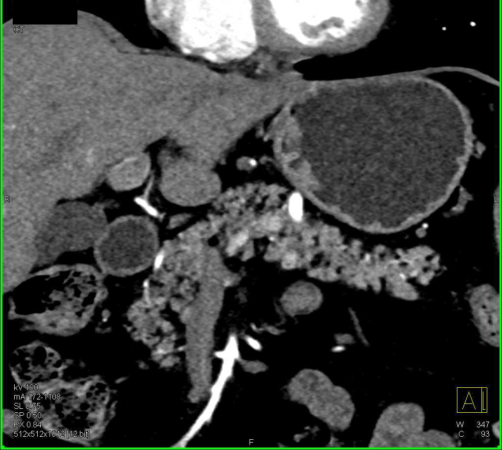 1cm Pancreatic Neuroendocrine Tumor (PNET) Body of the Pancreas - CTisus CT Scan