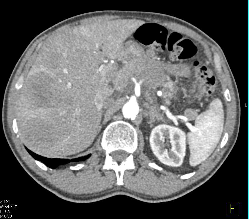 Pancreatic Adenocarcinoma with Liver Metastases and Vascular Involvement - CTisus CT Scan