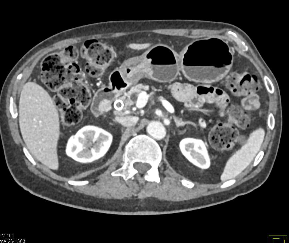 Pancreatic Cancer and Ectopic Pancreas in Duodenum - CTisus CT Scan