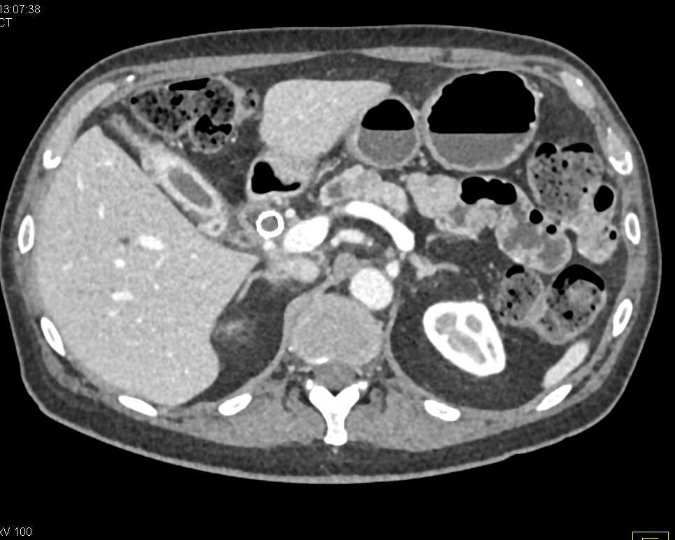 Pancreatic Cancer and Ectopic Pancreas in Duodenum - CTisus CT Scan